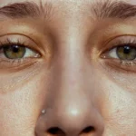 درمان منافذ باز پوست